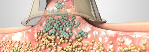 ponteira congela gordura localizada durante criolipólise
